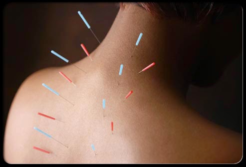 Acupuncture is a component of the health care system of China that can be traced back at least 2,500 years. The general theory of acupuncture is based on the premise that there are patterns of energy flow through the body that are essential for health. Disruptions of this flow are believed to be responsible for disease. Acupuncture may, it has been theorized, correct imbalances of flow at identifiable points close to the skin. The practice of acupuncture to treat identifiable path physiological (disease) conditions in American medicine was rare until the visit of President Richard M. Nixon to China in 1972. Since that time, there has been an explosion of interest in the United States and Europe in the application of the technique of acupuncture to Western medicine. Acupuncture is a family of procedures involving stimulation of anatomical locations on or in the skin by a variety of techniques. There are a variety of approaches to diagnosis and treatment in American acupuncture that incorporates medical traditions from China, Japan, Korea, and other countries. The most thoroughly studied mechanism of stimulation of acupuncture points employs penetration of the skin by thin, solid, metallic needles, which are manipulated manually or by electrical stimulation.