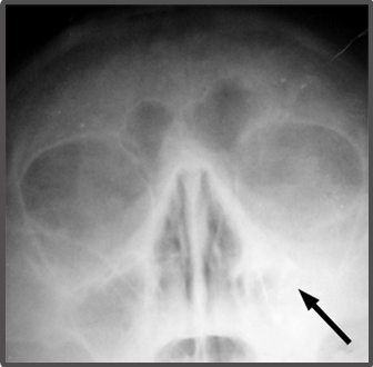 Sinusitis