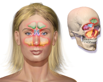 Illustration depicting sinusitis