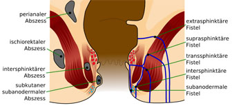 Different types of anal fistula (right side of image)