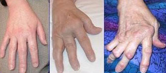 Hands affected by rheumatoid arthritis, an autoimmune form of arthritis