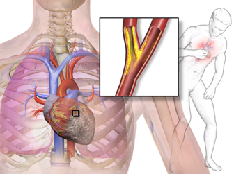 Illustration depicting angina