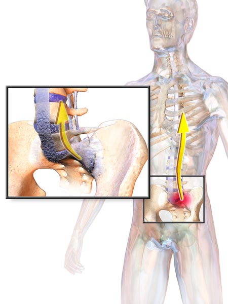 Ankylosing spondylitis