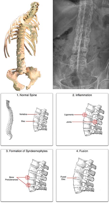 Ankylosing spondylitis