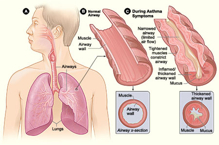 Asthma attack illustration