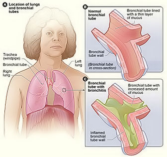 Bronchitis