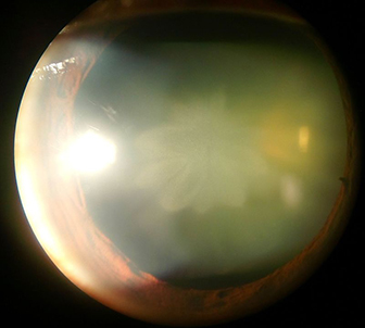 Cataract